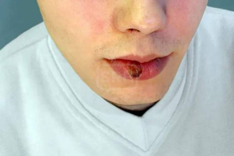 DÍA MUNDIAL DE LA SALUD SEXUAL | Alarma por un récord de contagios de sífilis en Argentina